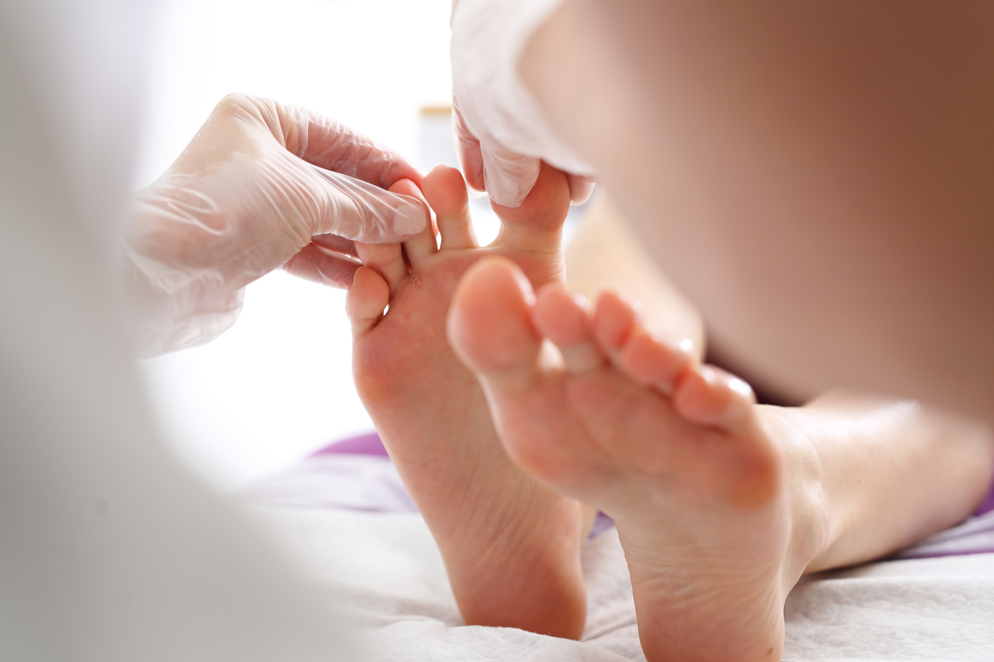 ingrown toenail remedies