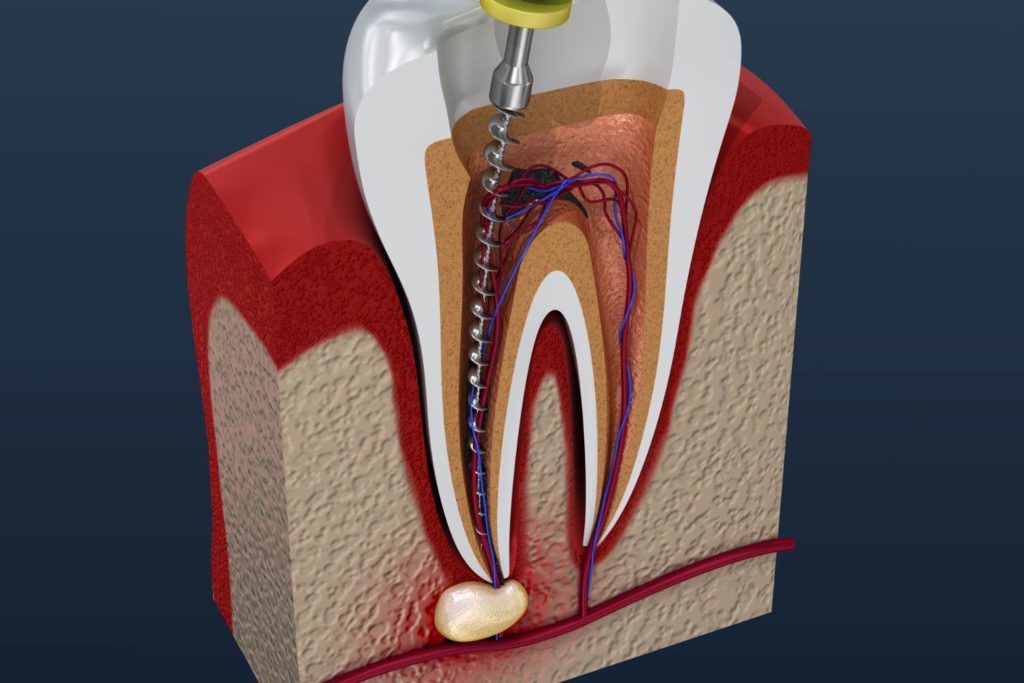 Want to know about dental root canal treatment in Dubai? A root canal can save your teeth and your smile by restoring or strengthening injured or discolored teeth.